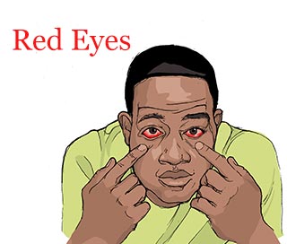 Ebola main symptoms, signs - redness eyes